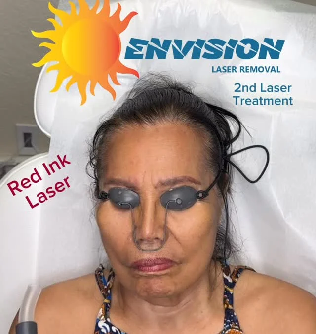 2nd Laser Treatment, Double Laser Treatment, and Notice the Fade from the first Treatment.  #envisionlasertattooremoval #portcharlottefl #sarasota #tattooremovalbeforeandafter #permanentmakeupremoval @followers