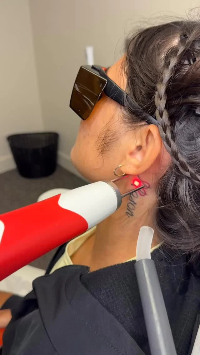 1st Laser Treatment #envisionlasertattooremoval #portcharlottefl #sarasota #englewoodfl