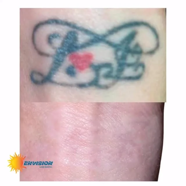 Done! 🏁✔️#envisionlasertattooremoval #portcharlottefl #veniceflorida #sarasota #northportfl