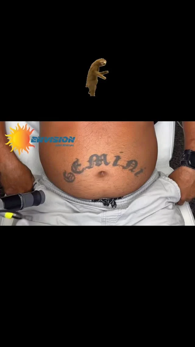 30 Year Old Tattoo!  Follow us to see the fast results!  #portcharlottefl #sarasota #veniceflorida #fortmeyers #northportfl