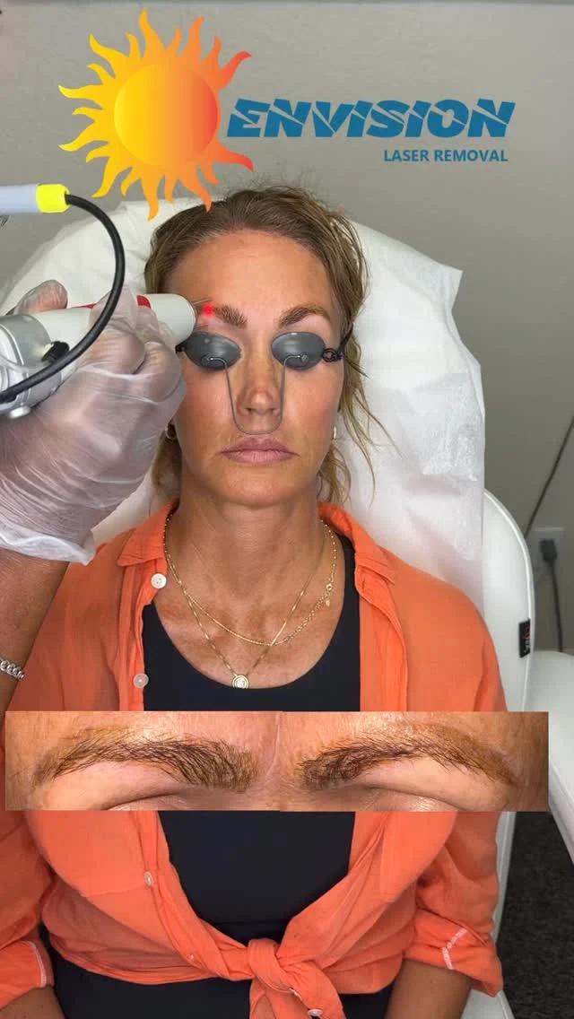 This is the 3rd laser treatment. The mid photos are the original and after 2 treatments.  The laser used effect ♥️💛🖤Ink #envisionlasertattooremoval #portcharlottefl #permanentmakeupremoval #tattooremovalbeforeandafter #sarasota