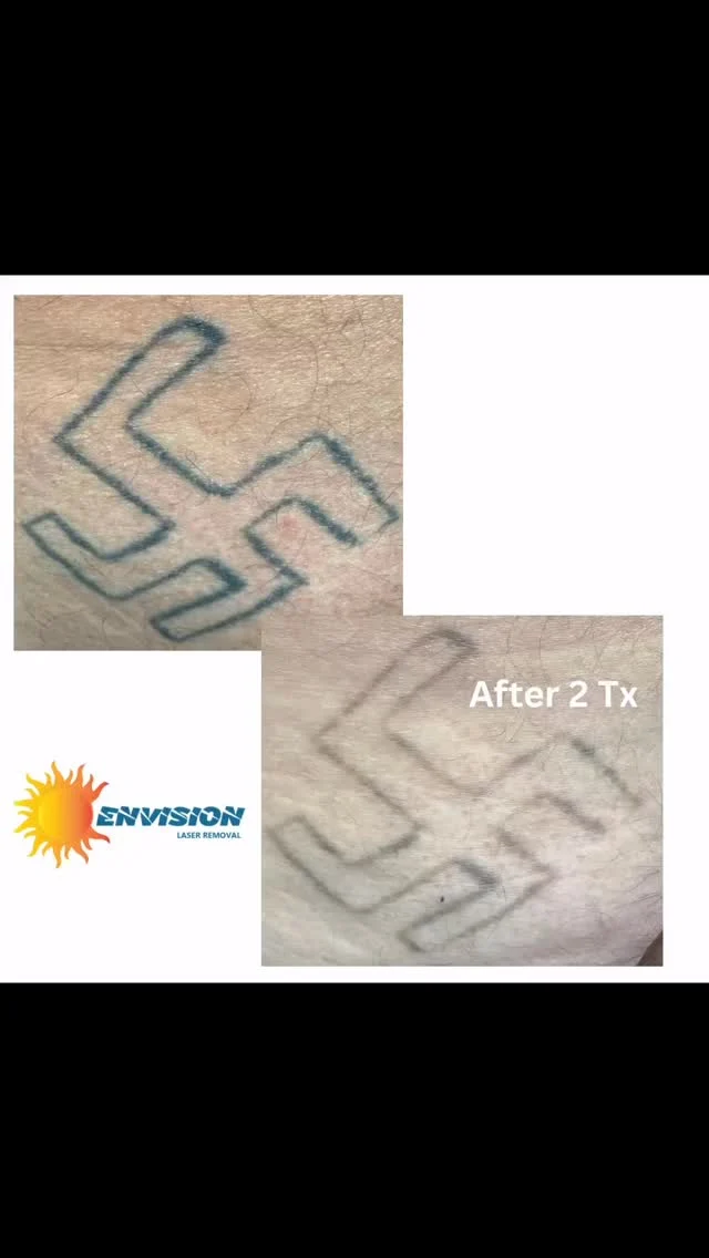 20+ Year old tattoo 2 treatments #envisionlasertattooremoval #portcharlottefl #sarasota #tattooremovalbeforeandafter #northportfl