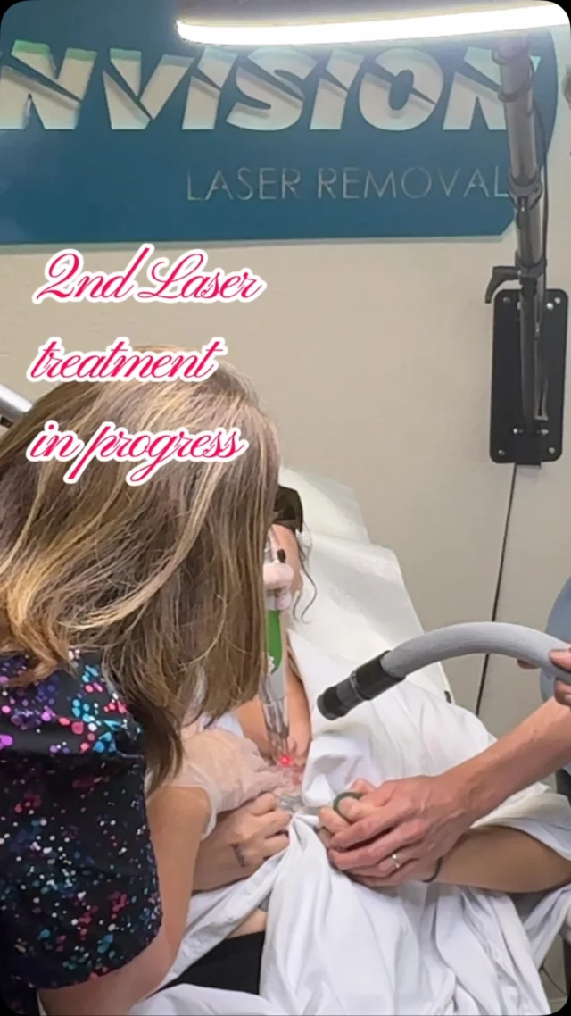 2nd Treatment in progress showing 1st & 2nd treatment results. Watch till the end.  Share with that friend who takes about removing their tattoo😊#envisionlasertattooremoval #portcharlottefl #sarasota #tattooremovalbeforeandafter #northportfl