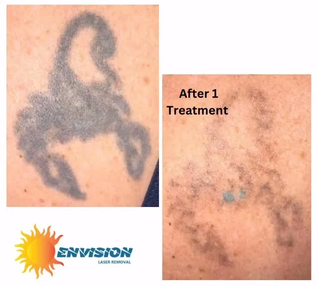 Thirty-Three (33) year old tattoo faded with one (1) laser treatment.  #envisionlasertattooremoval #portcharlottefl #sarasota #fortmeyers #northport_fl