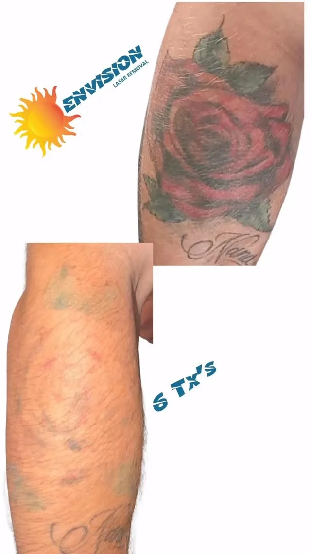 This tattoo is less < 10 Yrs, 6 Laser treatments started in 2022! #envisionlasertattooremoval #portcharlottefl #astanzalaser #sarasota #capecoralflorida