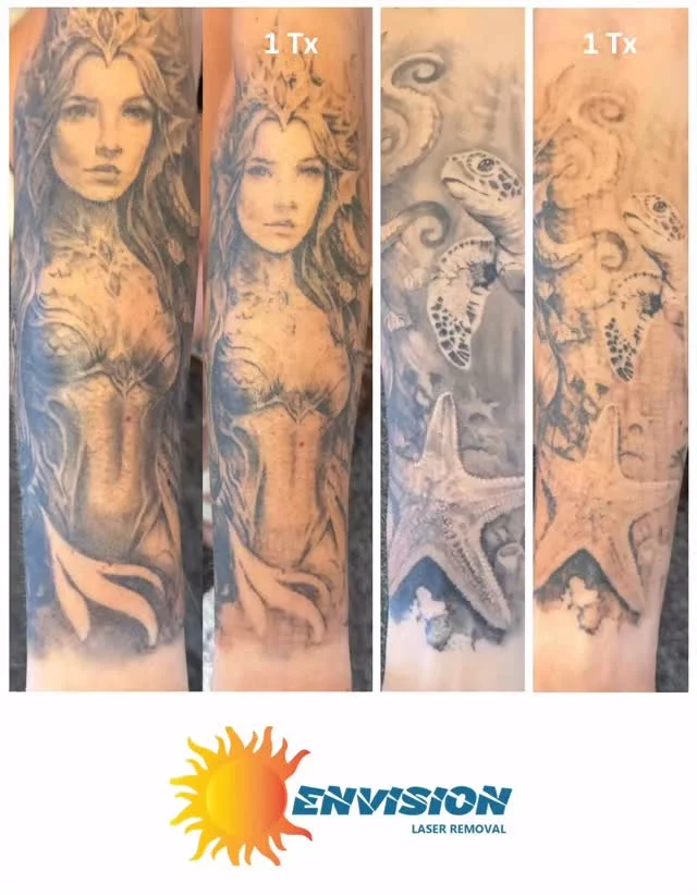 Two years old sleeve tattoo, ONE laser treatment #envisionlasertattooremoval #portcharlottefl #sarasota #tattooremovalbeforeandafter #northportfl
