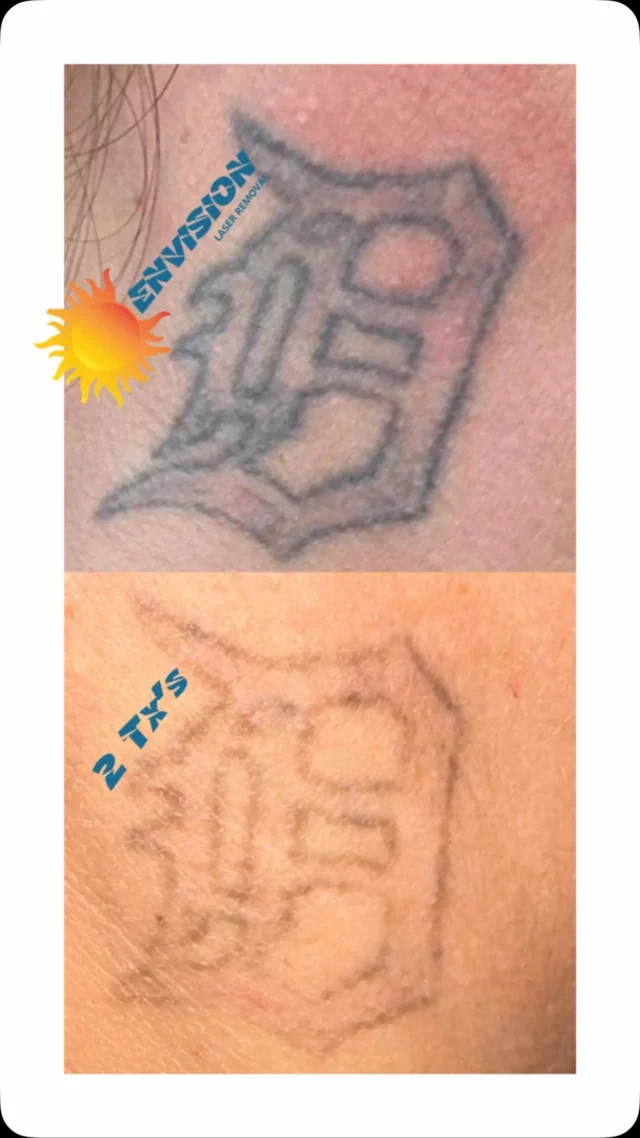 Two Laser treatments. #envisionlasertattooremoval #portcharlottefl #sarasota #northportfl #capecoralflorida