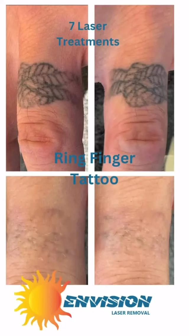 Seven (7) treatments #envisionlasertattooremoval #portcharlottefl #sarasota #tattooremovalbeforeandafter #capecoralfl