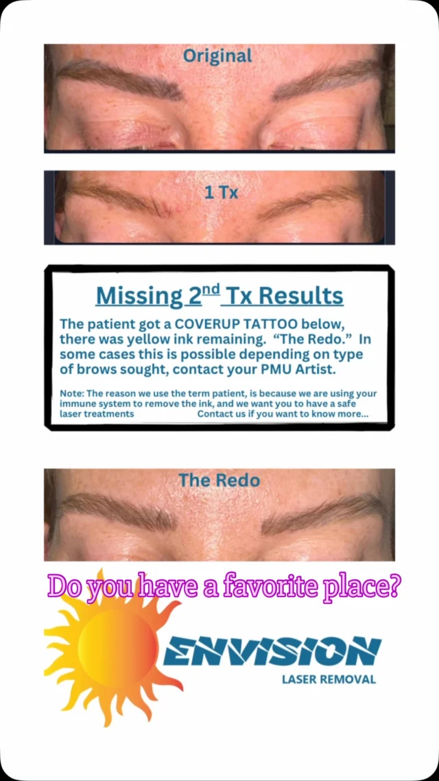#envisionlasertattooremoval #portcharlottefl #capecoralfl #sarasota #northportfl