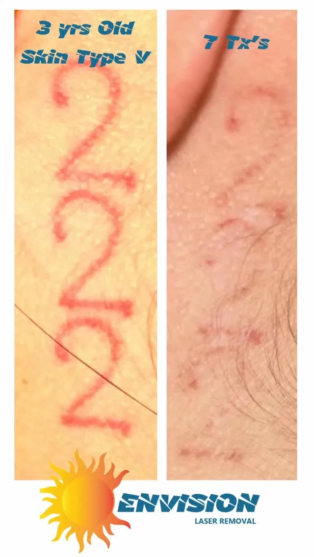 #envisionlasertattooremoval #portcharlottefl #sarasota #tattooremovalbeforeandafter #capecoralfl