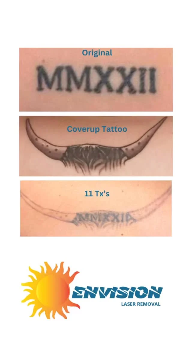 This is Stevie’s 11th treatment.  She has 2 coverups and one single installation tattoo we are removing.  #envisionlasertattooremoval #portcharlottefl #tattooremovalbeforeandafter #Northportfl #capcoralfl