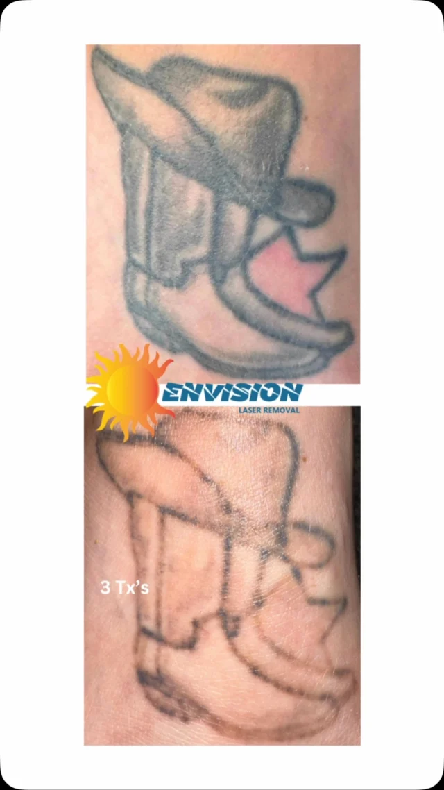 3 laser treatments #envisionlasertattooremoval #portcharlottefl #sarasota #northportfl #capecoralflorida