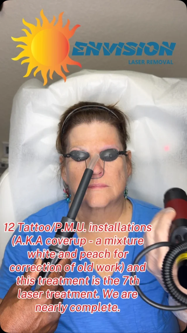 12 Tattoo/P.M.U. installations
(A.K.A coverup - a mixture white and peach for correction of old work) and this treatment is the 7th
laser treatment. We are nearly complete. #envisionlasertattooremoval  #permanentmakeupremoval #portcharlottefl #sarasota #veniceflorida