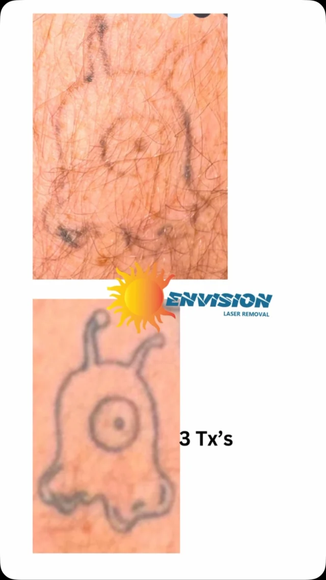 Laser Tattoo Removal Treatments #portcharlottefl #northportfl #sarasota #puntagorda #arcadiafl