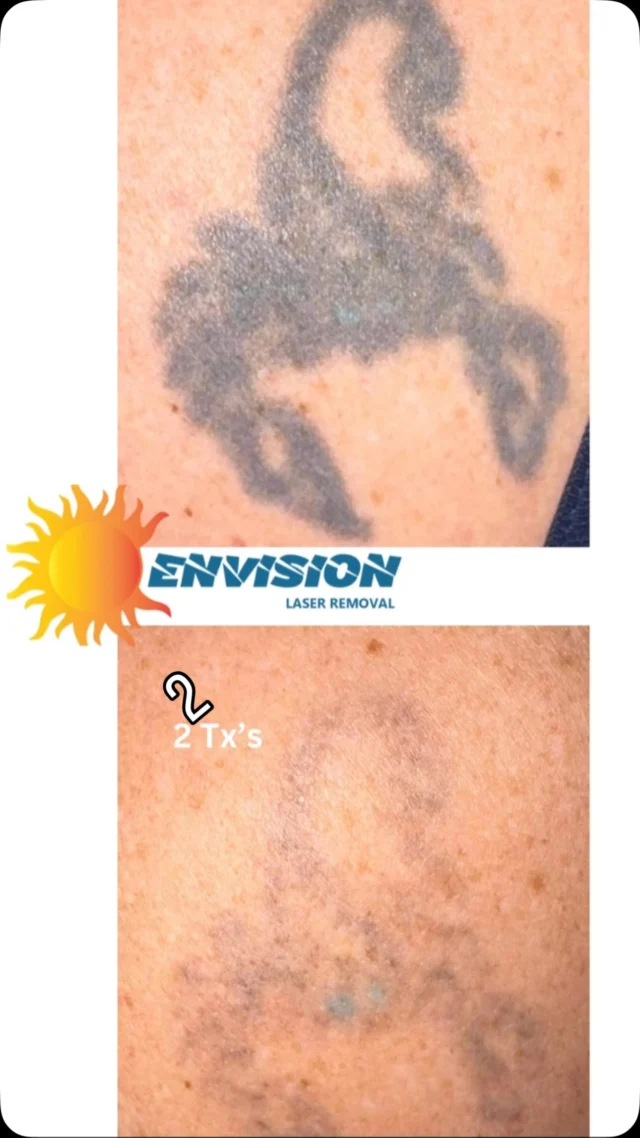 2 Tattoo Laser Removal session!
#envisionlasertattooremoval #portcharlottefl #tattooremovalbeforeandafter #astanzatrinity #sarasota
