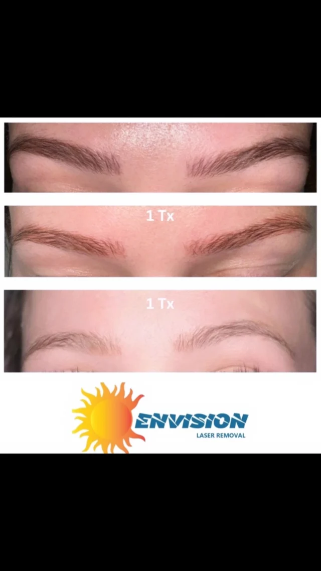 Today was a 🙌 WIN 🏆 for Her, the ink was in the skin lite and one (1) laser treatment in Red and Brownish-Black. 🏁. #envisionlasertattooremoval #portcharlottefl #tattooremovalbeforeandafter #permanentmakeupremoval #sarasota