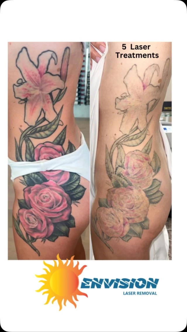 5 Laser Treatments, 11 Years Old, she was it gone -NOW!  #envisionlasertattooremoval #portcharlottefl #sarasota #fortmeyers #tattooremovalbeforeandafter