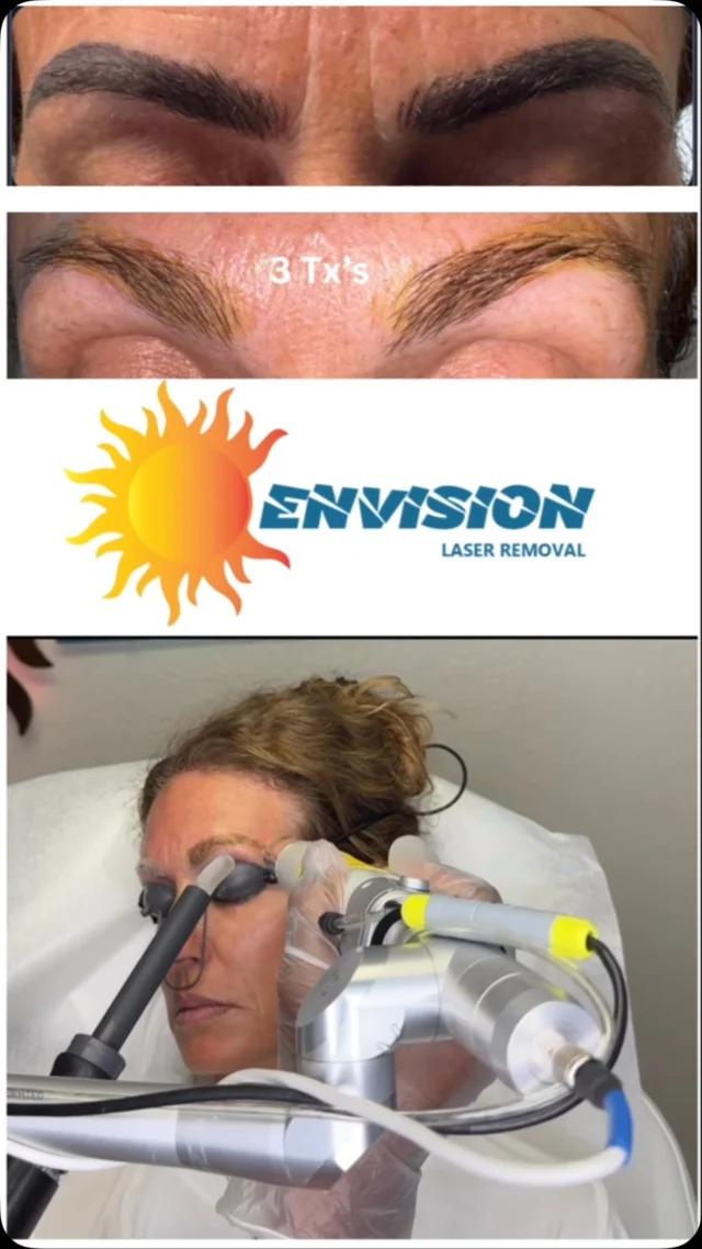 She had several installations and corrections cause a saturation of Yellow🌕. The goal is always a full reset to normal skin tone and appearance that there was no ink. #envisionlasertattooremoval #portcharlottefl #tattooremovalbeforeandafter #permanentmakeupremoval #sarasota