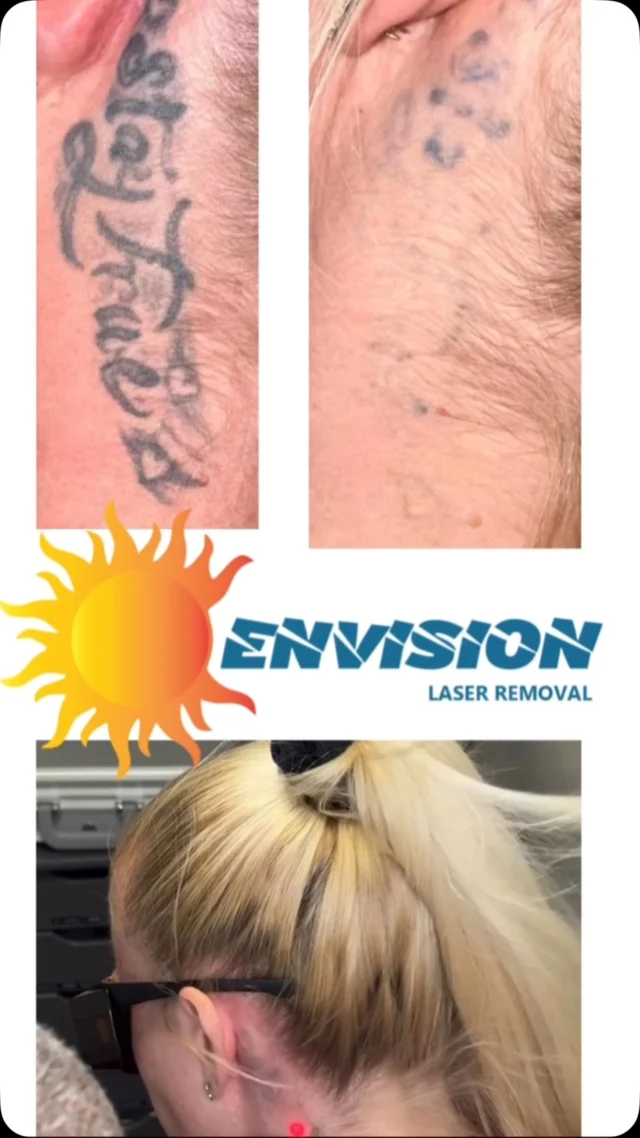7 Laser treatments, 1 year and 2 months. Laser removal for tattoos is a process with an achievable goal of full removal.  Trust the process.  #envisionlasertattooremoval #portcharlottefl #sarasota #tattooremovalbeforeandafter #astanzatrinity