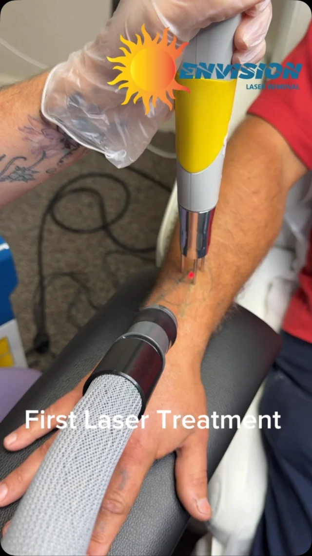 FIRST LASER TREATMENT #envisionlasertattooremoval #portcharlottefl #sarasota #Northportfl