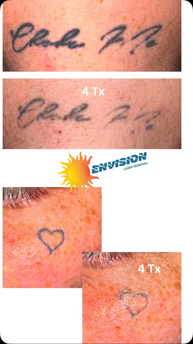 Trust the process!
#envisionlasertattooremoval #portcharlottefl #sarasota #northportfl #fortmeyers
