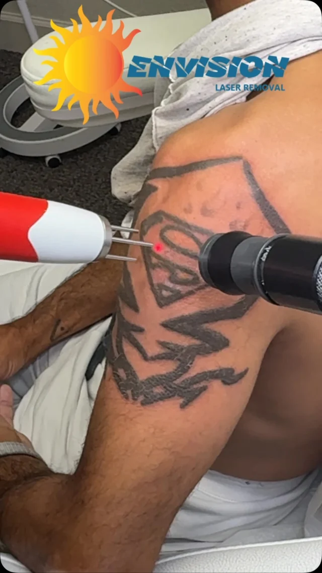3rd Treatment #envisionlasertattooremoval #portcharlottefl #sarasota #veniceflorida #tattooremovalbeforeandafter