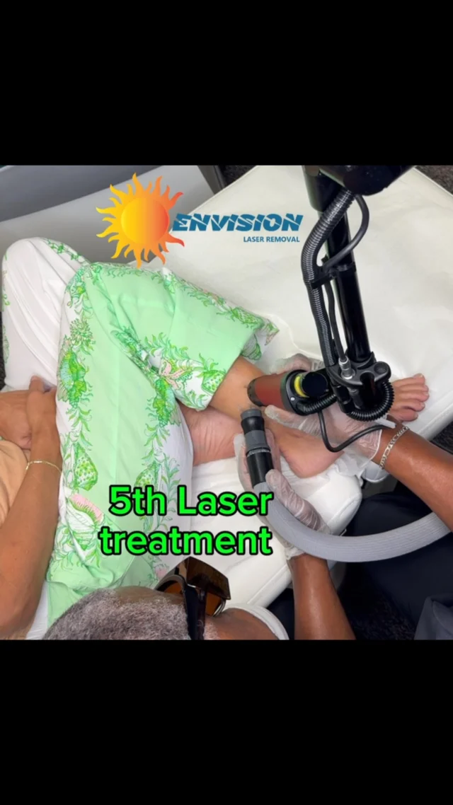 Envision laser provided four laser treatments. This patient had treatment in Colorado and was not satisfied.  She comes down to Florida, visits us, thank you for the trust.  Recently, we had a few inquiries about treatment pain as you can see here we also give the patient breaks; in addition, to using Cryo cooling at -32° temperature. The total treatment time for this tattoo is three minutes with brakes and this is a 3 inch tattoo.  #envisionlasertattooremoval #portcharlottefl #sarasota #tattooremovalbeforeandafter #fortmeyers