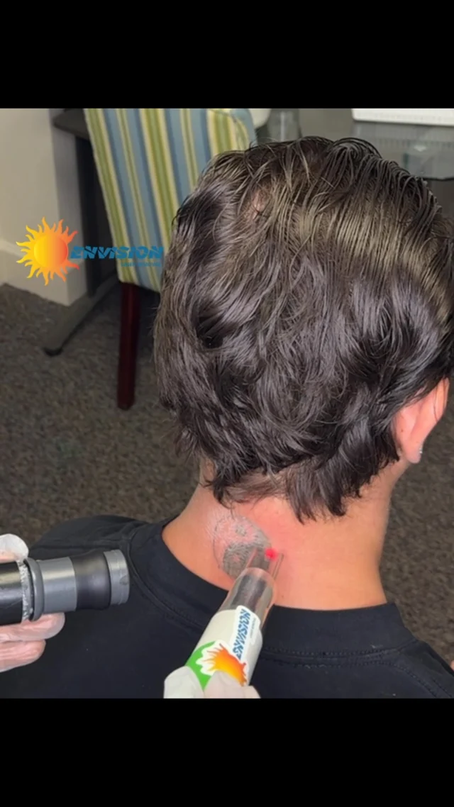 This a 5 yr old tattoo and the first tattoo was treated then covered, and today we are restarting.  #envisionlasertattooremoval #portcharlottefl #sarasota #tattooremovalbeforeandafter #northport_fl