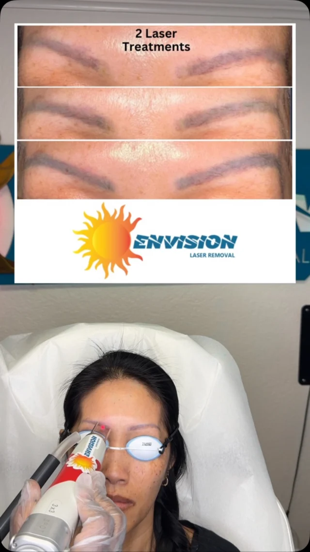 3rd Laser Treatment (Saturated Brows 3 installations) #envisionlasertattooremoval #portcharlottefl #permanentmakeupremoval #sarasota #puntagordafl
