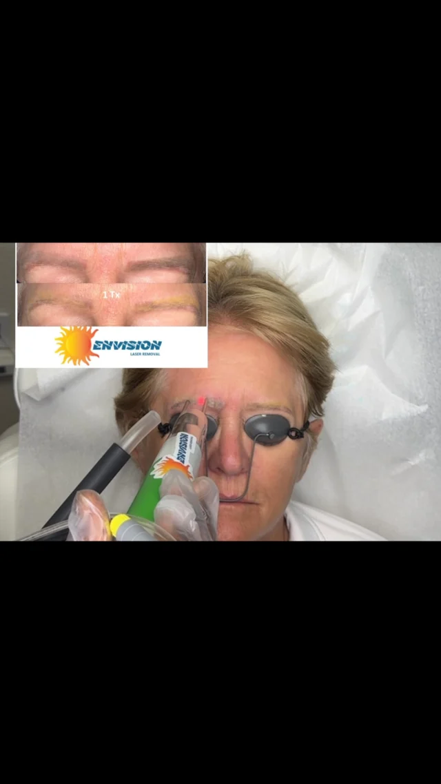 2nd laser treatment #envisionlasertattooremoval #portcharlottefl #permanentmakeupremoval #sarasota #Northportfl