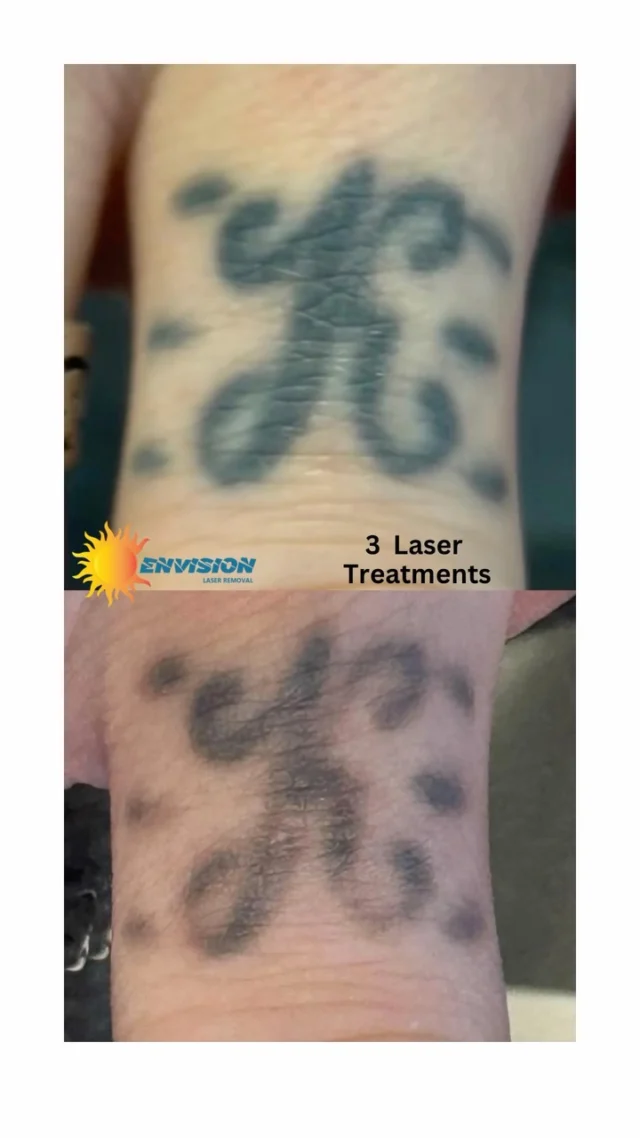 3 Laser Treatments #envisionlasertattooremoval #portcharlottefl #sarasota #northportfl #puntagordafl