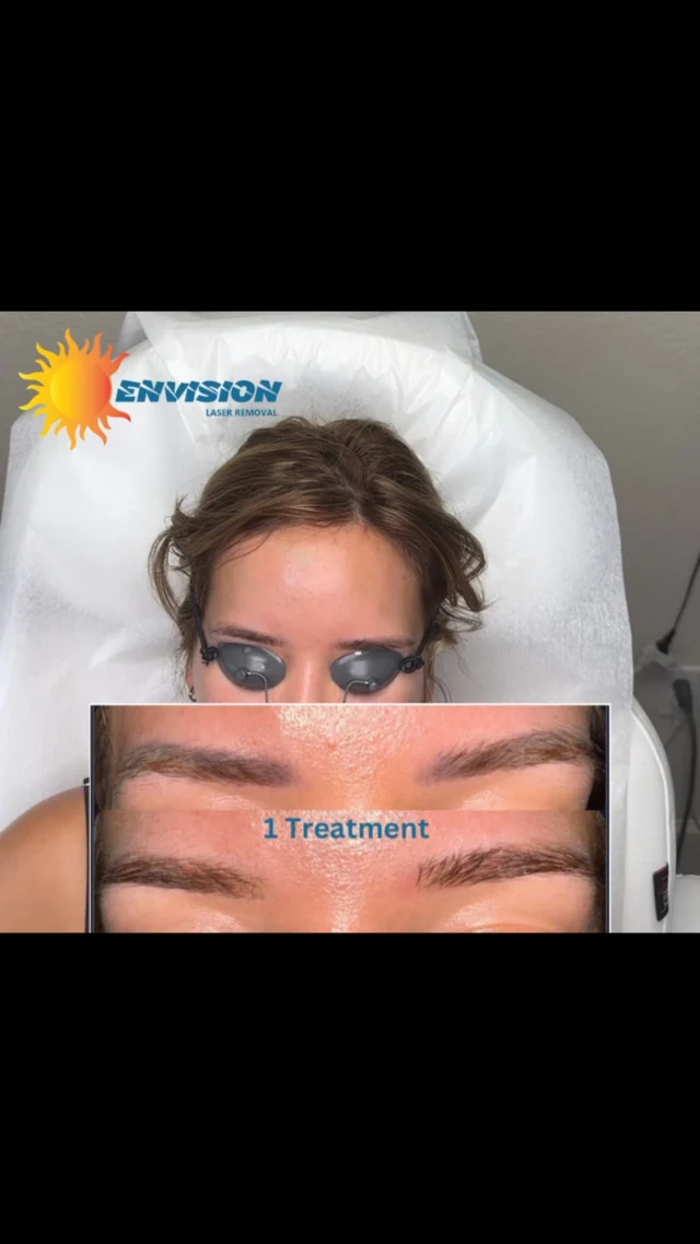 Number 2, treating  black 🖤, yellow 💛and red ♥️ Stick around for the last treatment at the end, she asked for a little correction in the skin. ☑️ + ✅ #envisionlasertattooremoval #portcharlottefl #Northportfl #puntagorda #sarasota