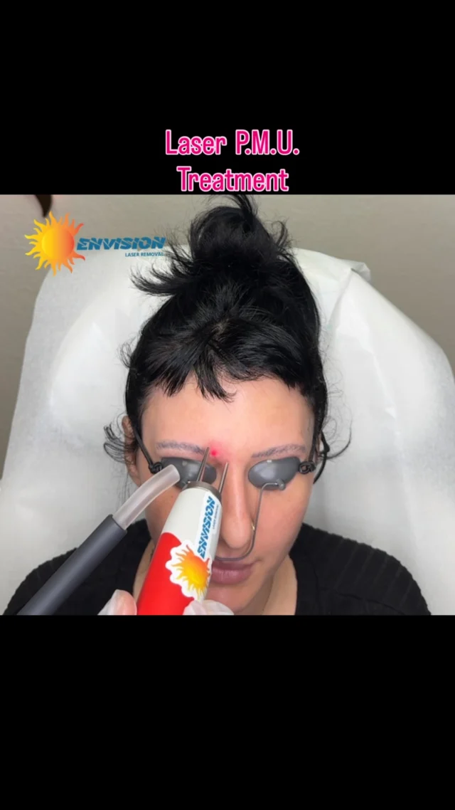 First laser treatment and she may need one more. Watch till 12 Seconds… #envisionlasertattooremoval #portcharlottefl #puntagordafl #Northportfl #sarasota