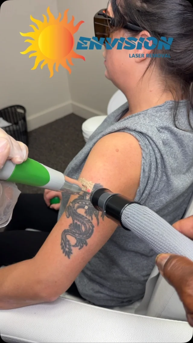 1st Laser treatment!  It’s going to be a great fade on a 30 year old tattoo.
#envisionlasertattooremoval #portcharlottefl #sarasota #tattooremovalbeforeandafter #puntagordafl