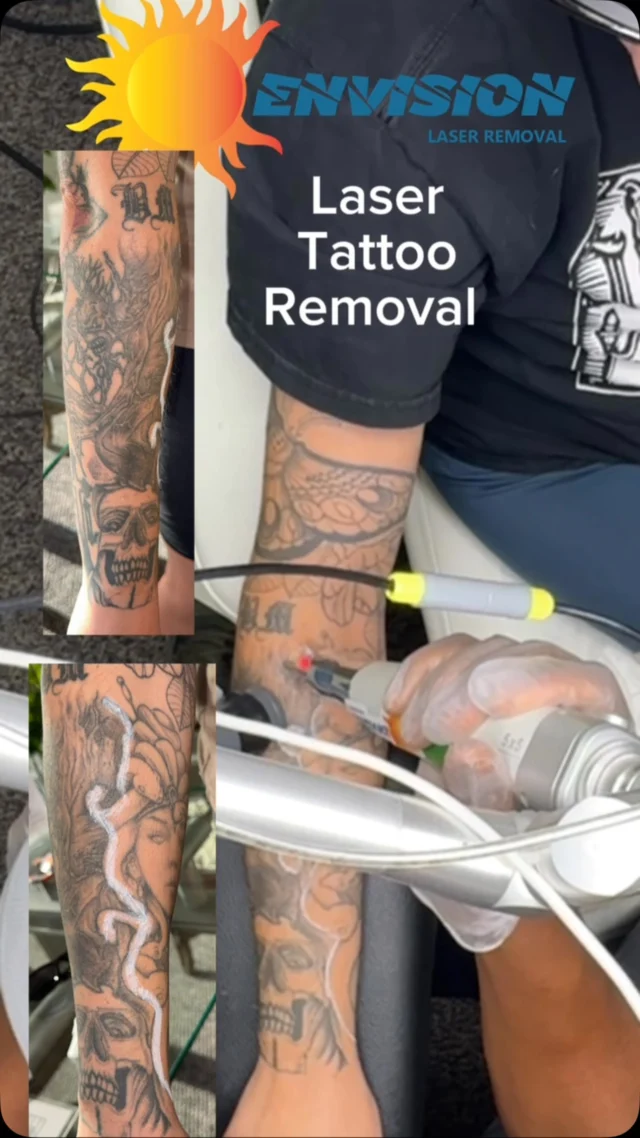 1st laser treatment-fade for a coverup.  #envisionlasertattooremoval #portcharlottefl #sarasota #permanentmakeupremoval #puntagordafl